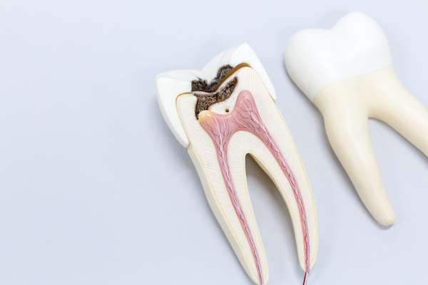 Ask a General Dentist: Is a Tooth Dead After a Root Canal from Lida Davani, DDS in Los Angeles, CA