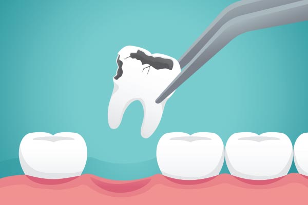 Ask a General Dentist: What Happens to Your Tooth After Extraction from Lida Davani, DDS in Los Angeles, CA