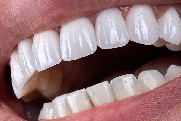 Dental Bonding: An Easy Way To Repair Chips, Cracks, And Gaps