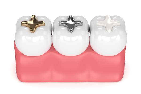 A General Dentist Discusses Different Filling Options from Lida Davani, DDS in Los Angeles, CA